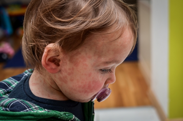 Most kids recover from measles. But the virus can be deadly and can erase the immune system's memory.